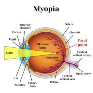 Myopia Control